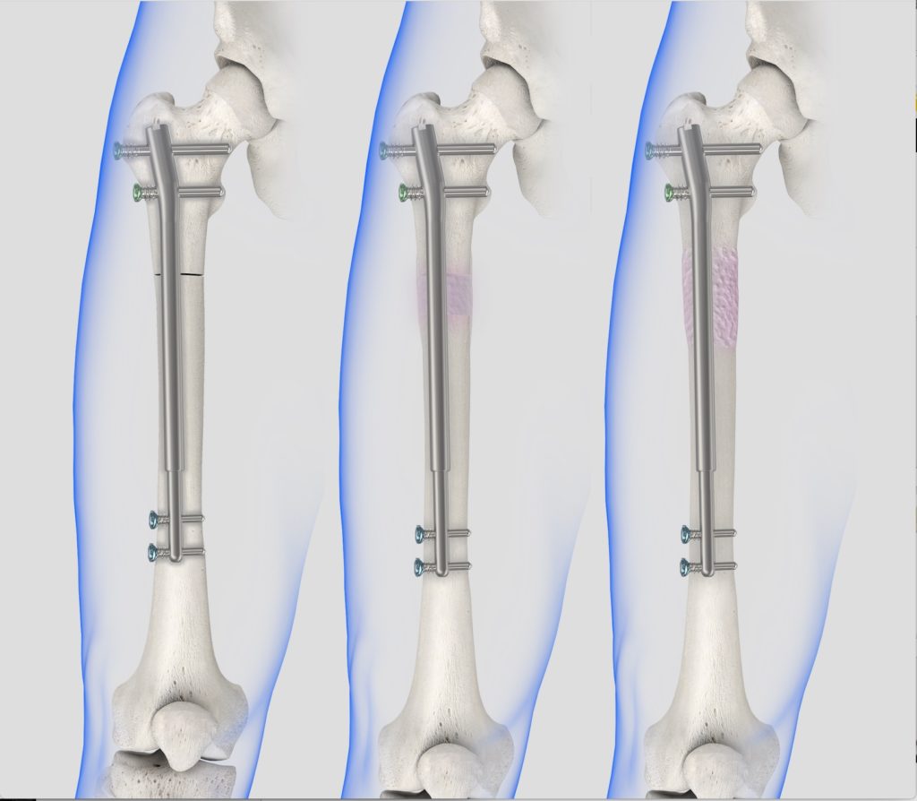 Correcting bone deformities | health & wellness colorado