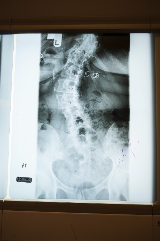 Spine Xray