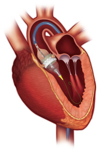 The Edwards SAPIEN 3 transcatheter heart valve expands into place in the heart with the help of an inflatable balloon catheter.